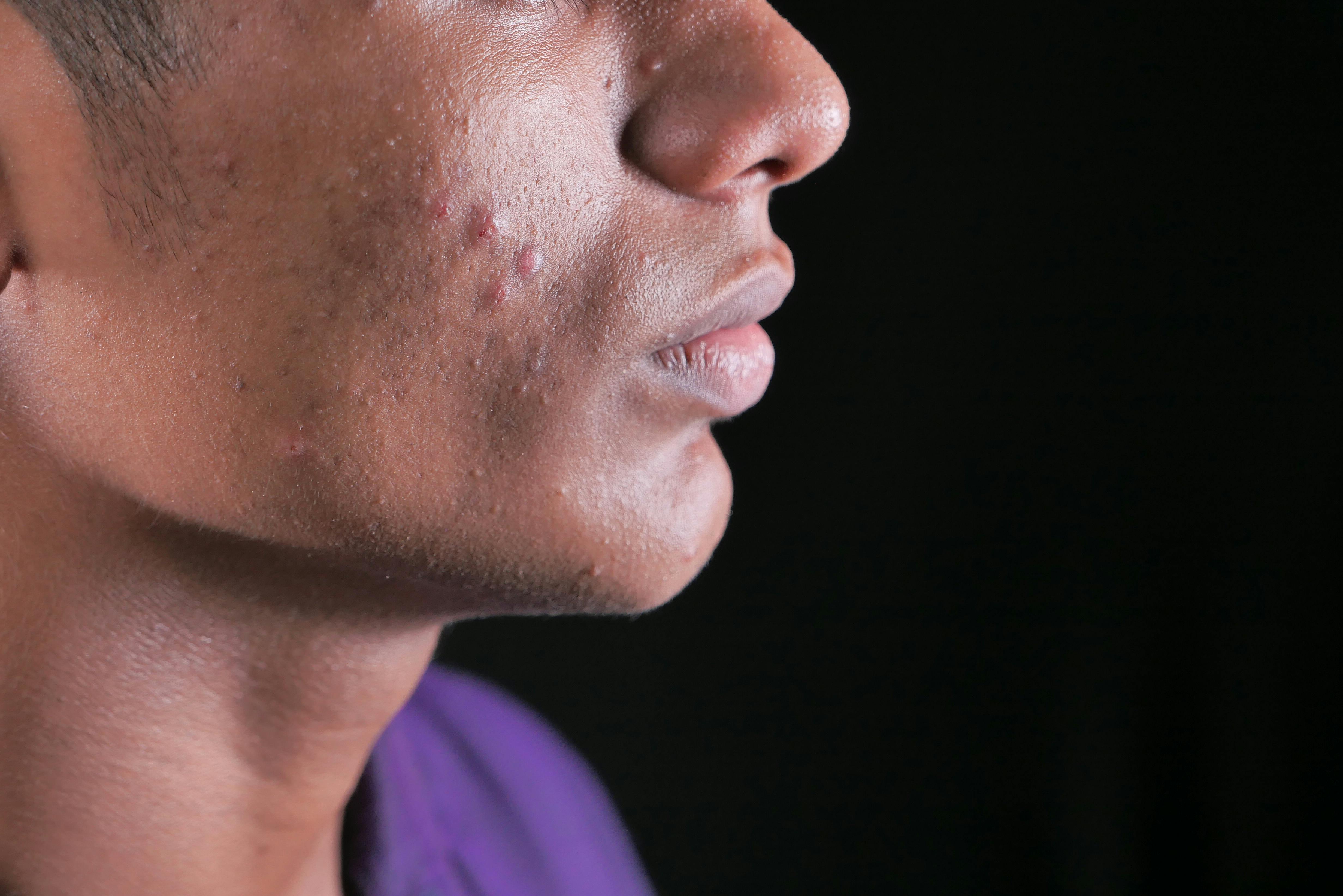 Close-up side profile of a young man with acne on cheek and jawline